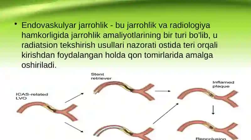 Endovaskulyar jarrohlik 2
