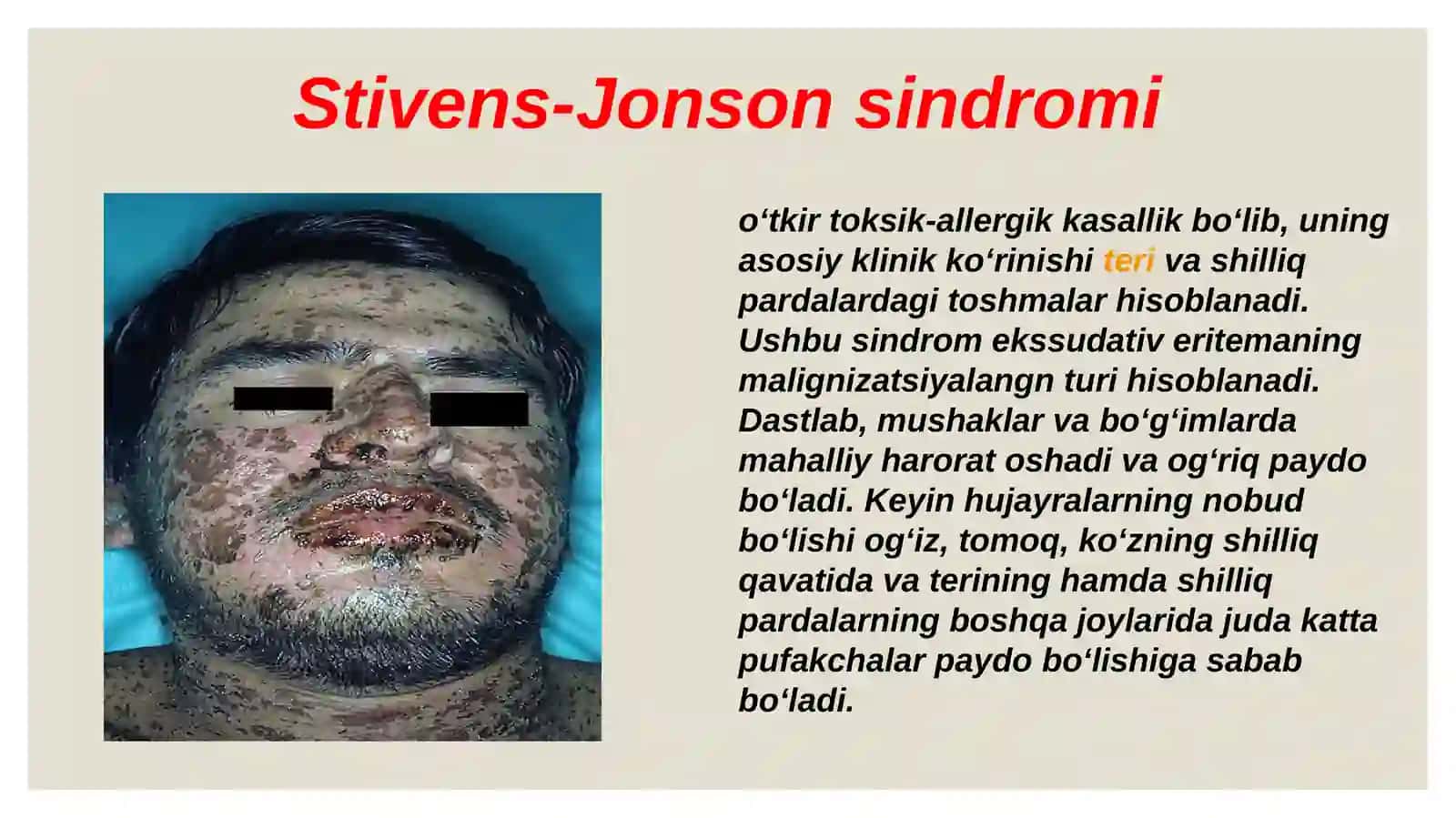Stivens-djonson va layell sindromlari 2