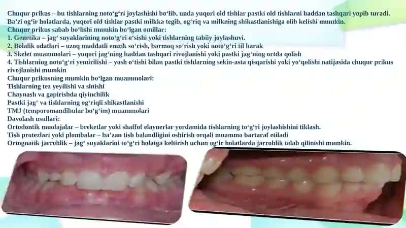 Ochiq prikus muammosi 2