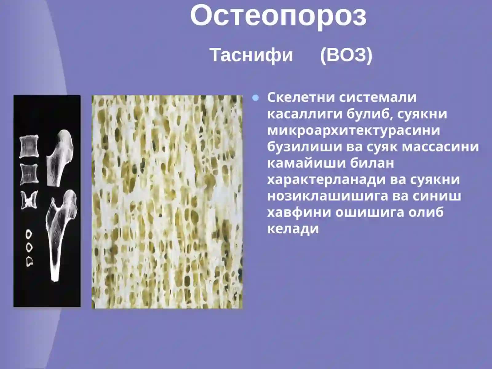 Остеопороз 2