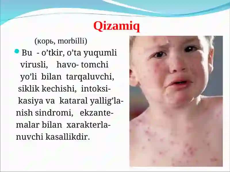 Qizamiq, qizilcha 2