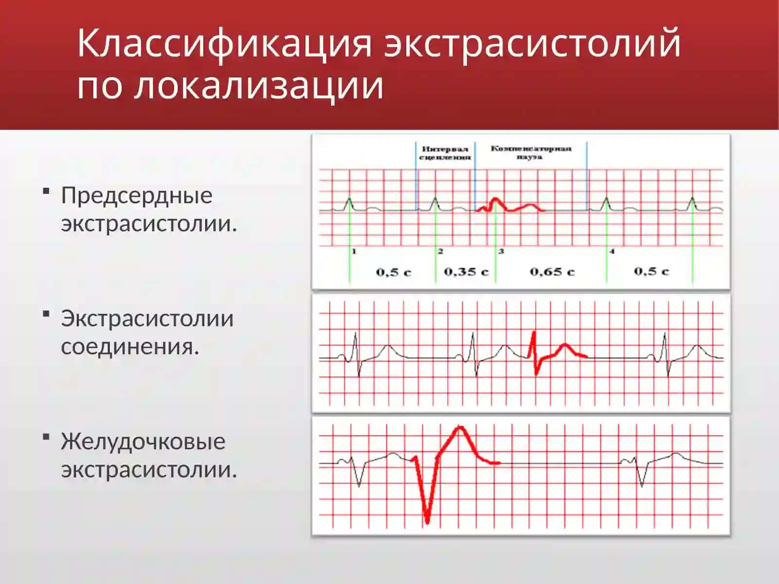 Экстрасистолия 2