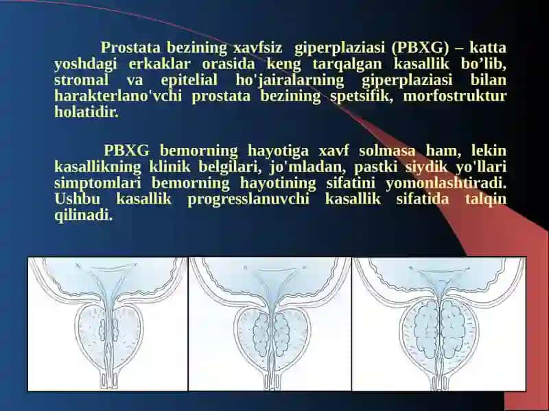PROSTATA BEZININGXAVFSIZ GIPERPLAZIASI 2