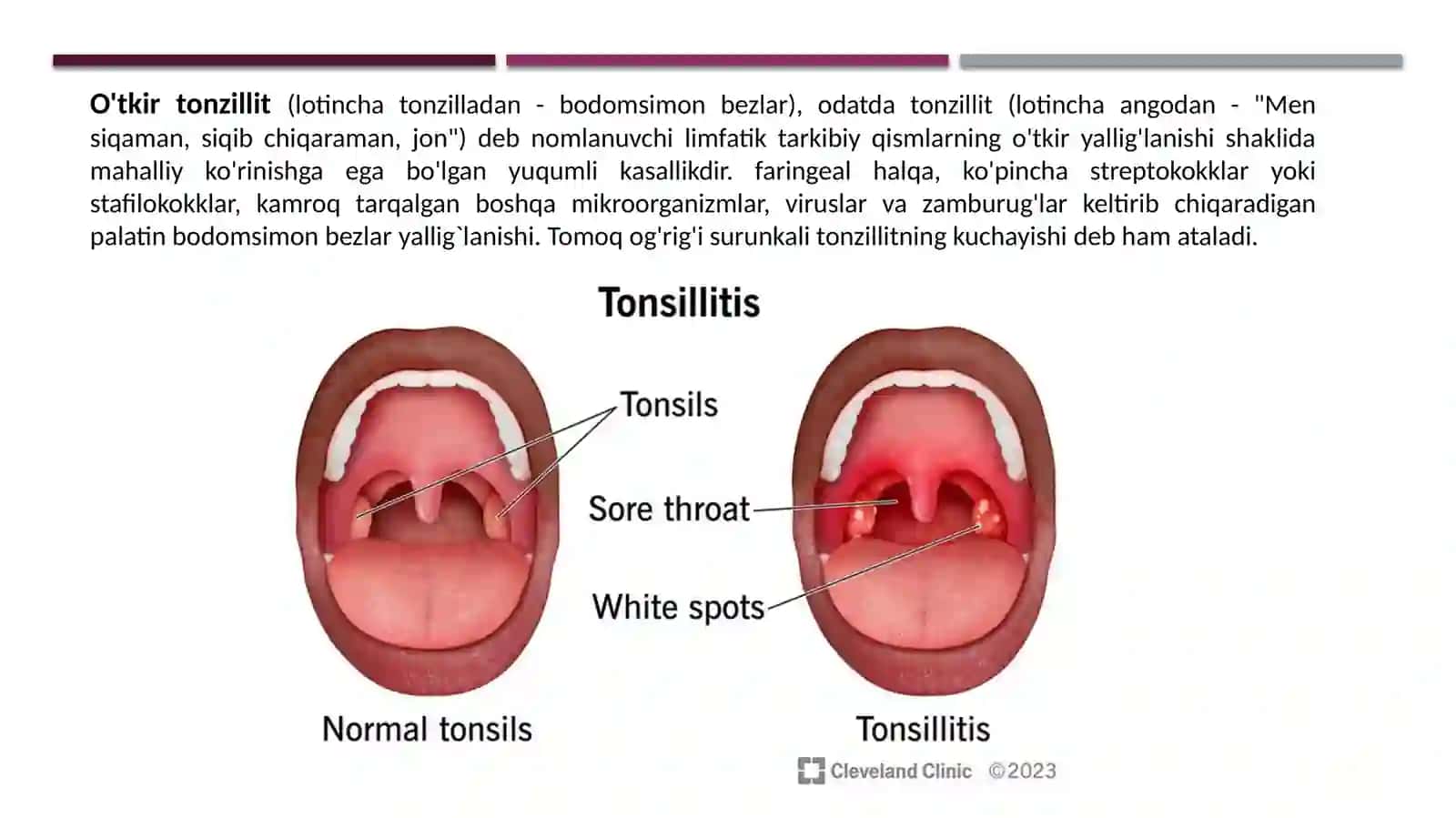 Angina va uning asoratlari 2