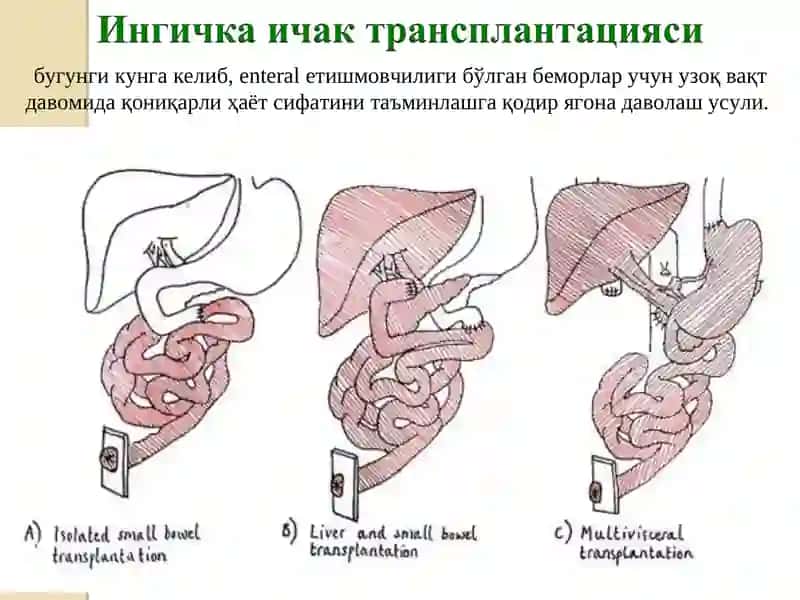 Ichaklar transplantatsiyasi 2