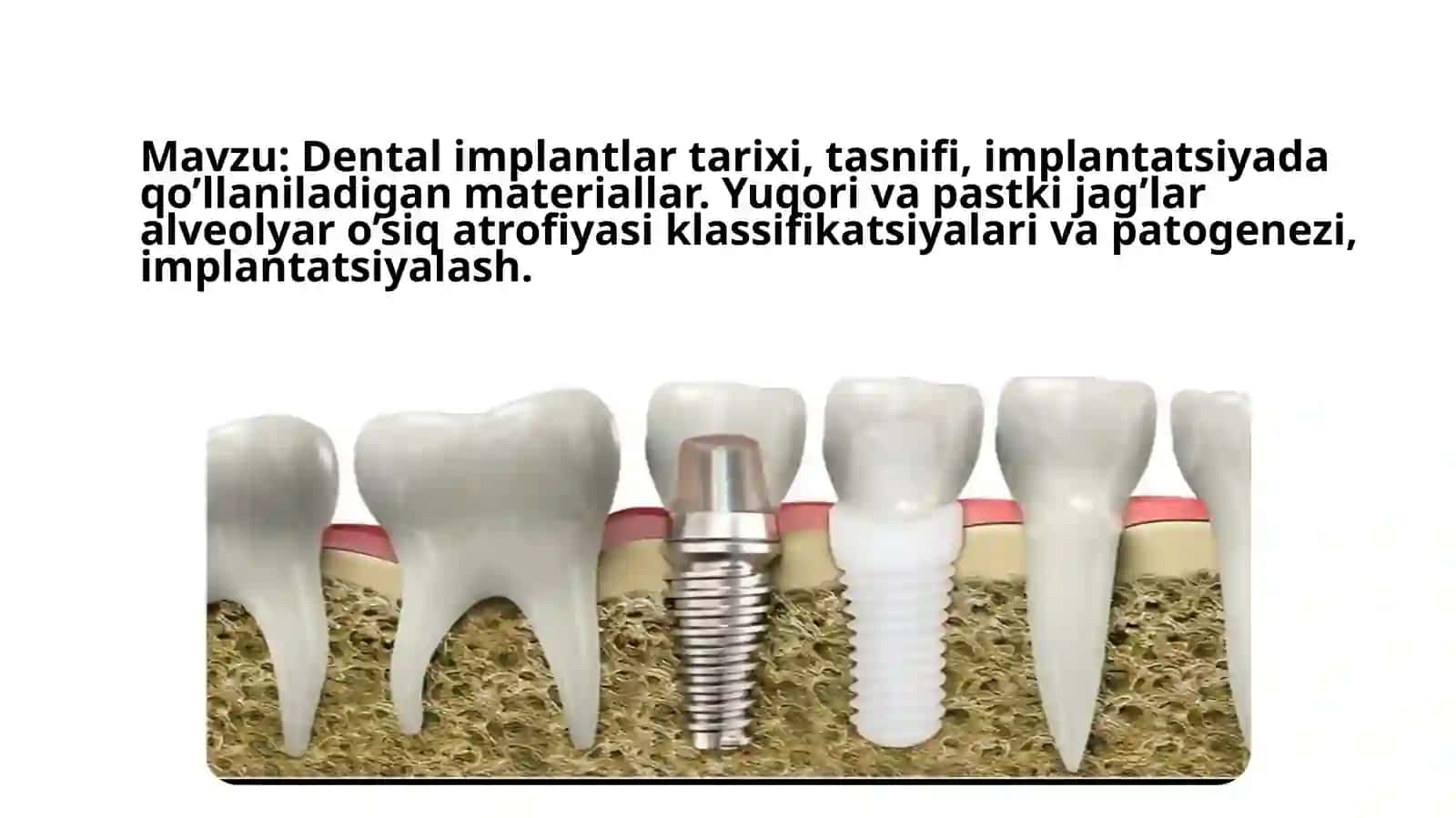 Dental implantologiya 2