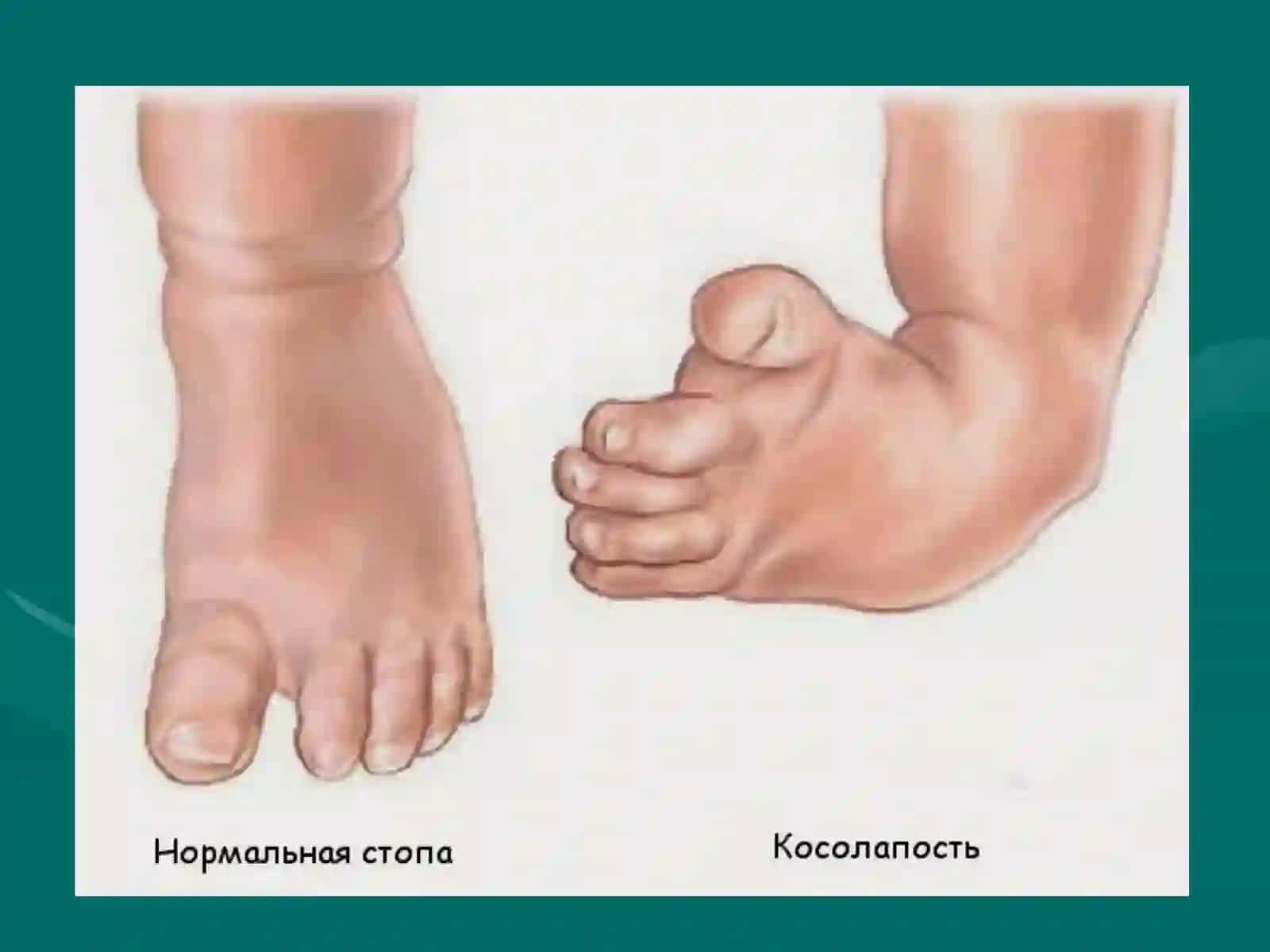 Врожденная косолапость (clubfoot) 2