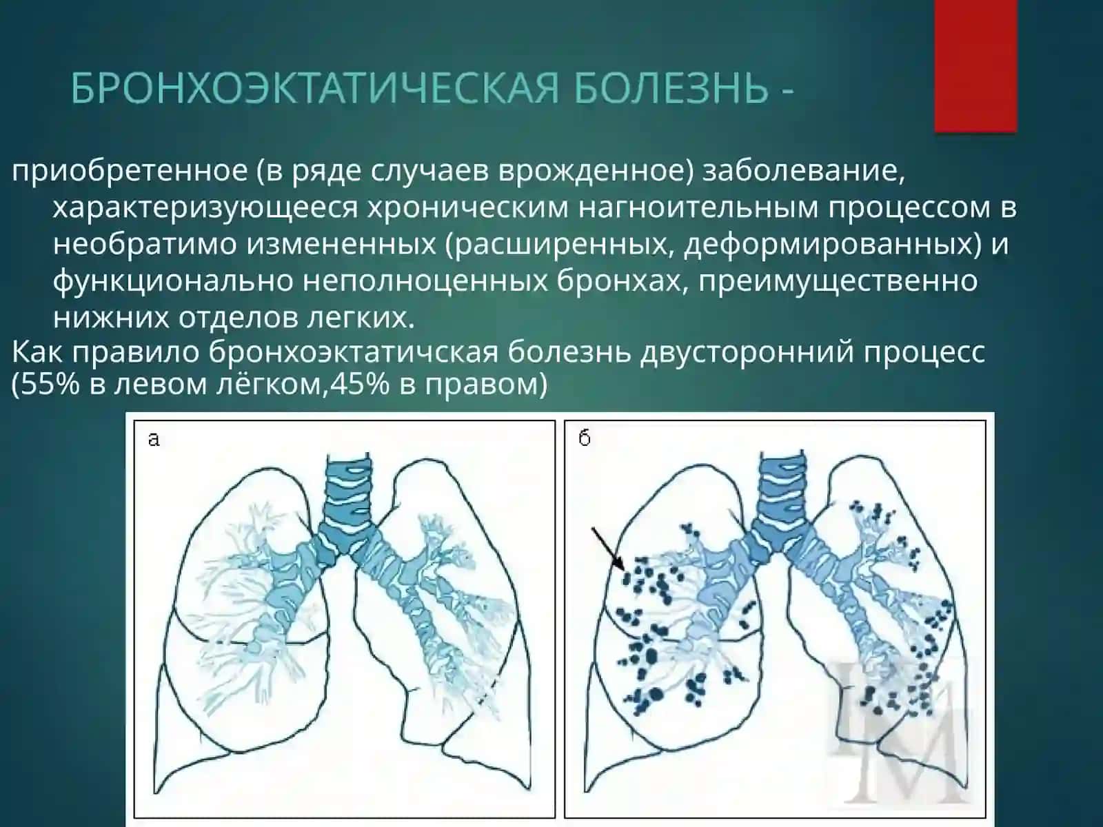 Бронхоэктатическая болезнь 2