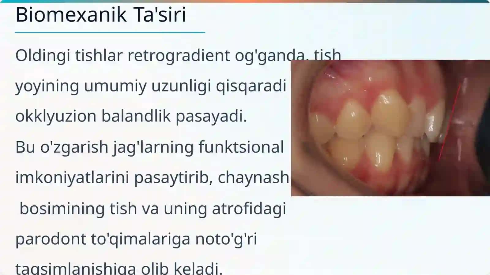 Tishlar retruziyasi 2