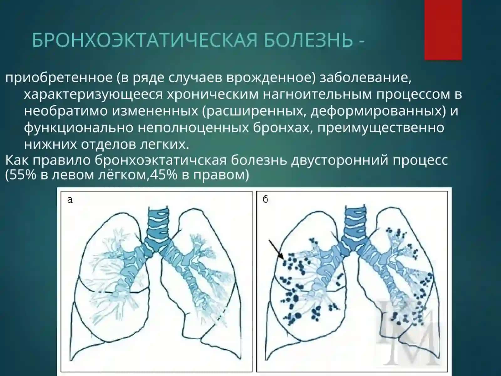 Bronxoekoz kasalligi БРОНХОЭКТАТИЧЕСКАЯ БОЛЕЗНЬ 2