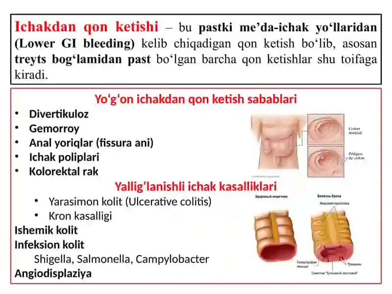 Ichakdan qon ketishi 2