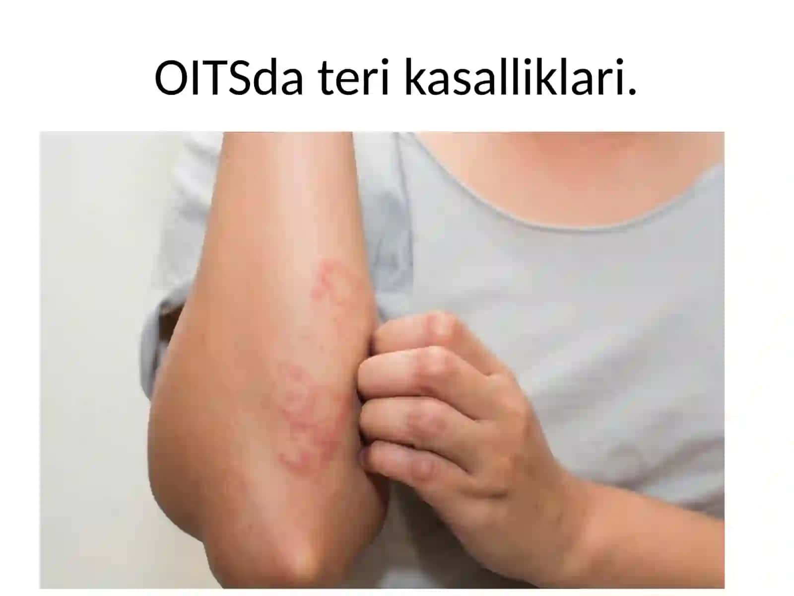 OITSda teri kasalliklari 2