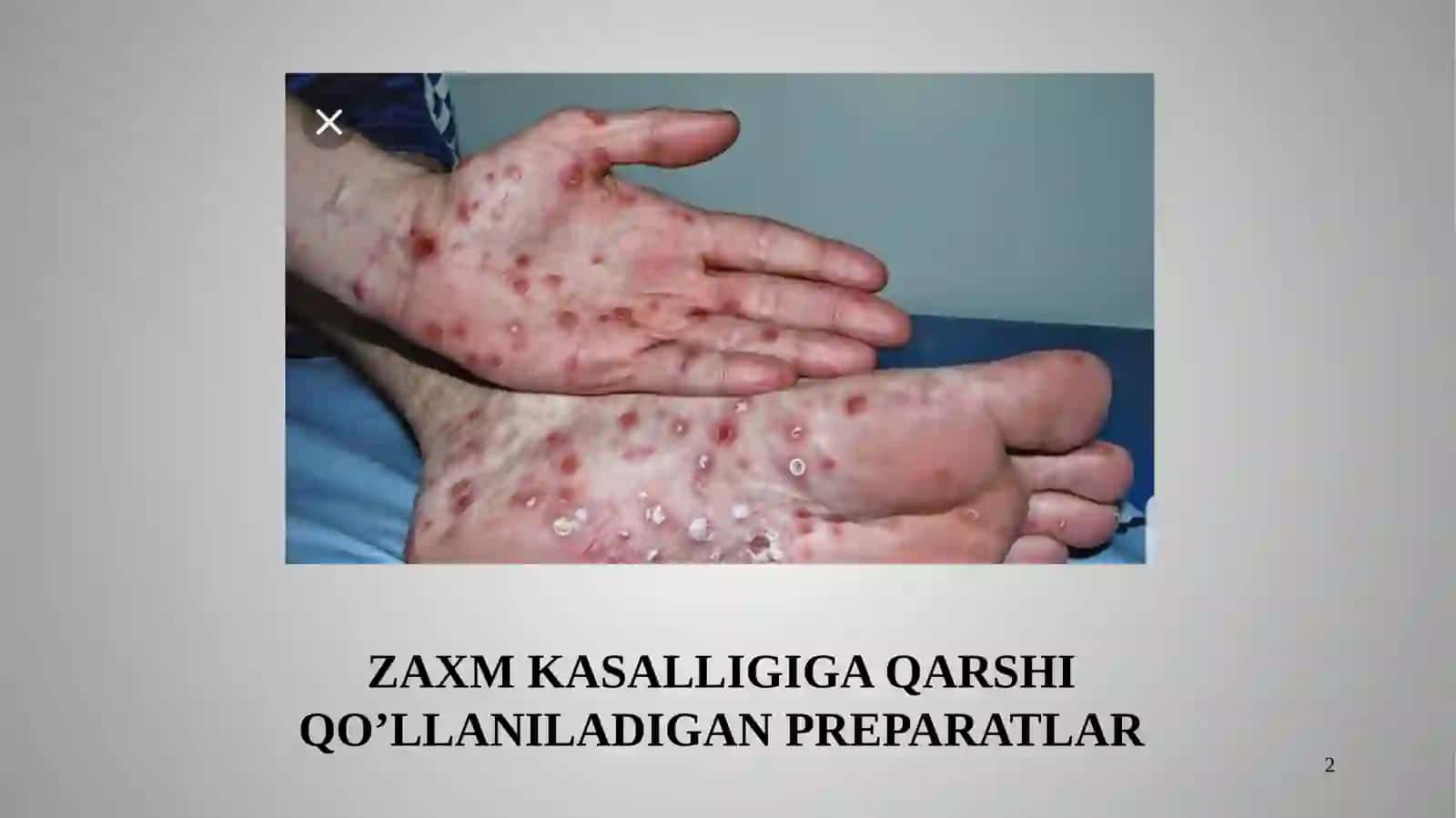 ZAHMGA, SILGA QARSHI VOSITALAR 2