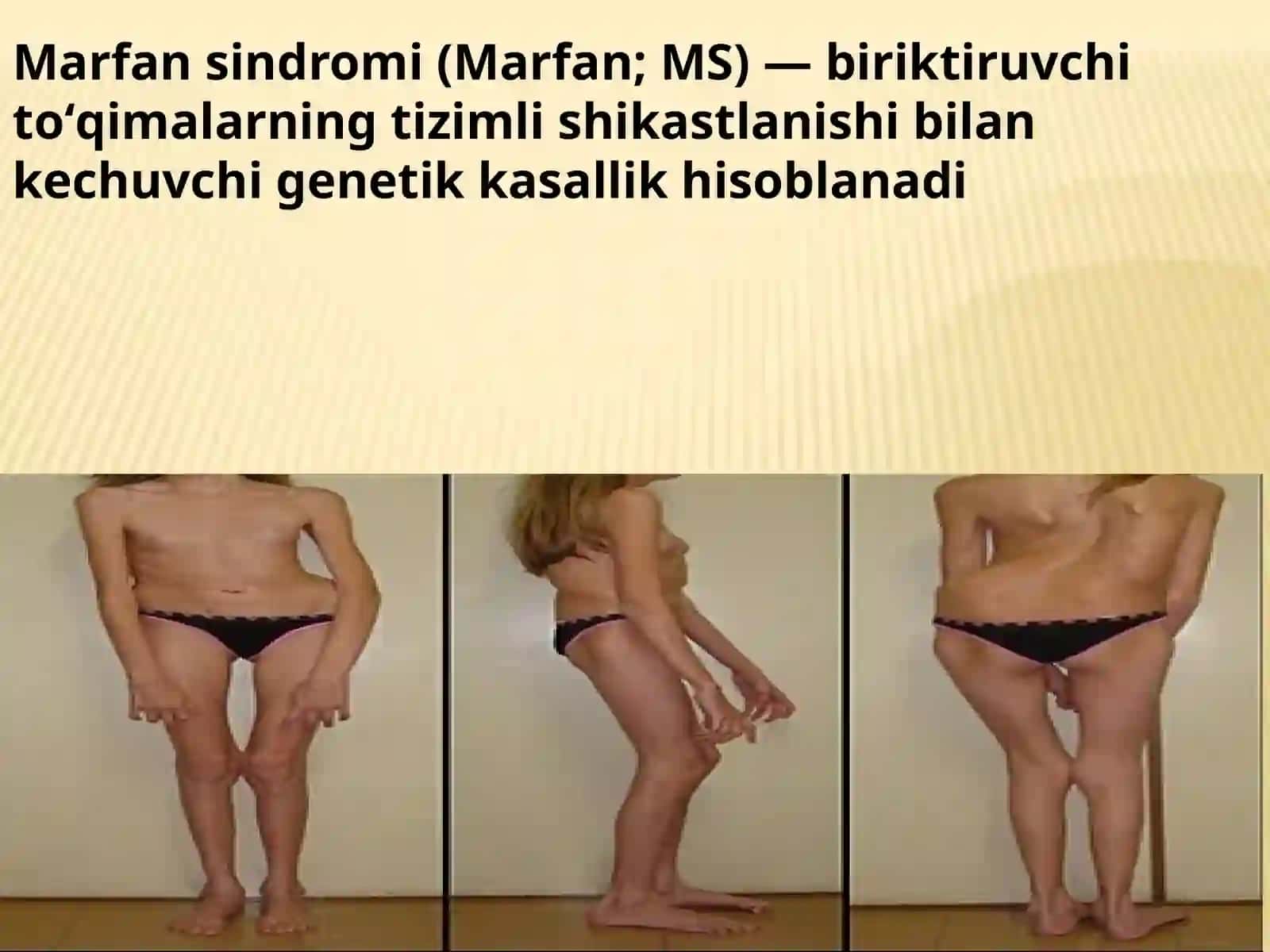 Marfan sindromi 2