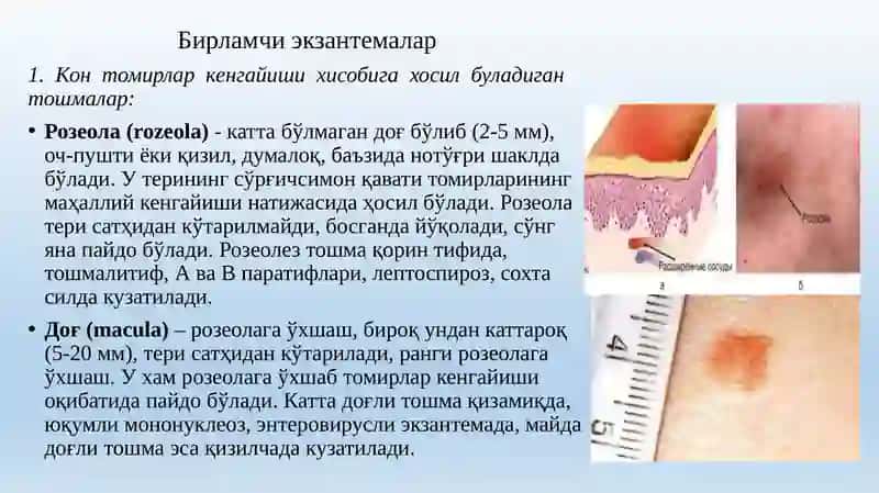 Розеола (rozeola) 2