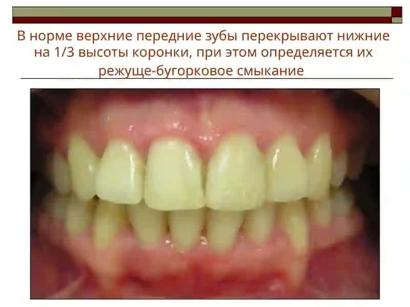 Глубокий прикус 2