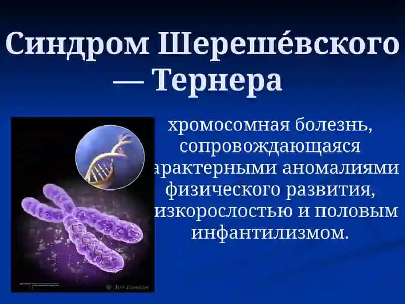 Синдром Шерешевского-Тернера 2