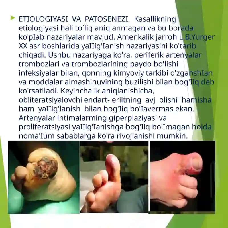 Obliteratsiyalovchi endarterit 2