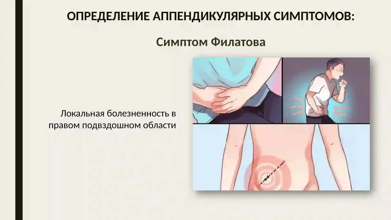 Ректальное исследование при тазовом аппендиците 2