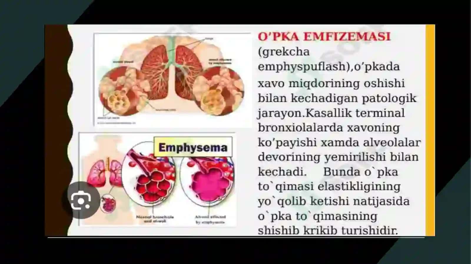 O’pka emfizemasi 2
