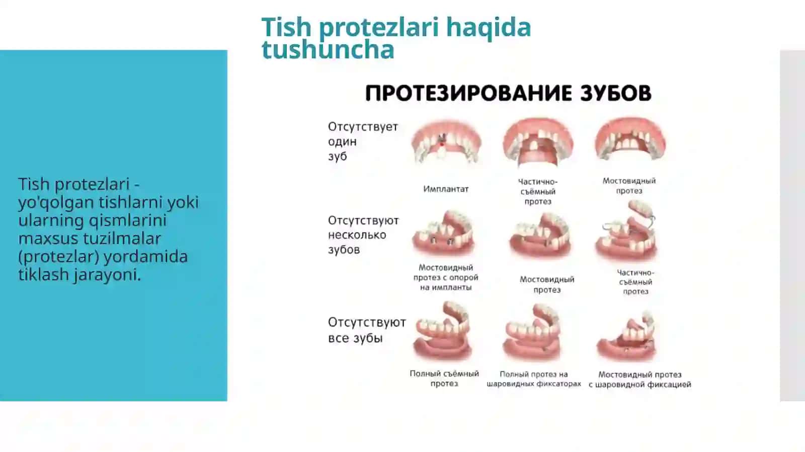 Tish protezlari haqida tushuncha 2