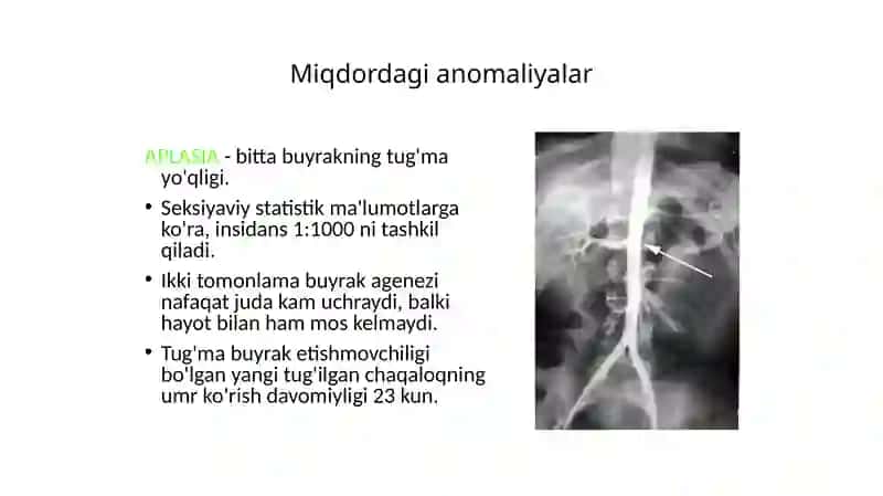 Buyraklar Tug’ma Nuqsonlari 2
