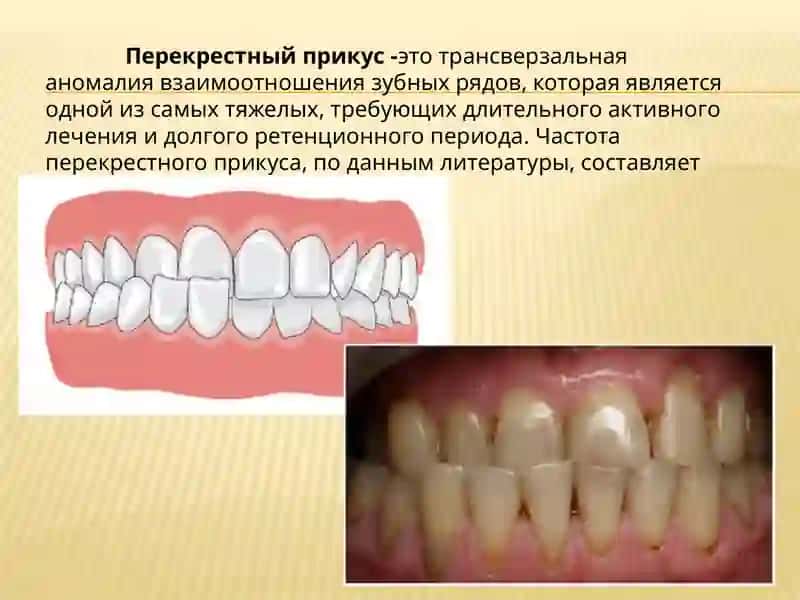 Перекрестный прикус 2