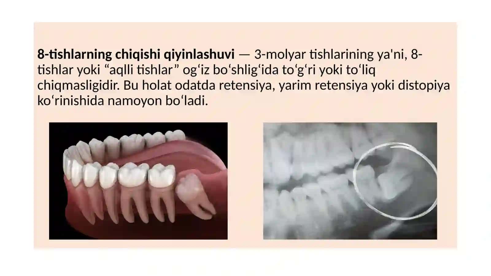 8-tishlarning chiqishiqiy inlashuvi 2