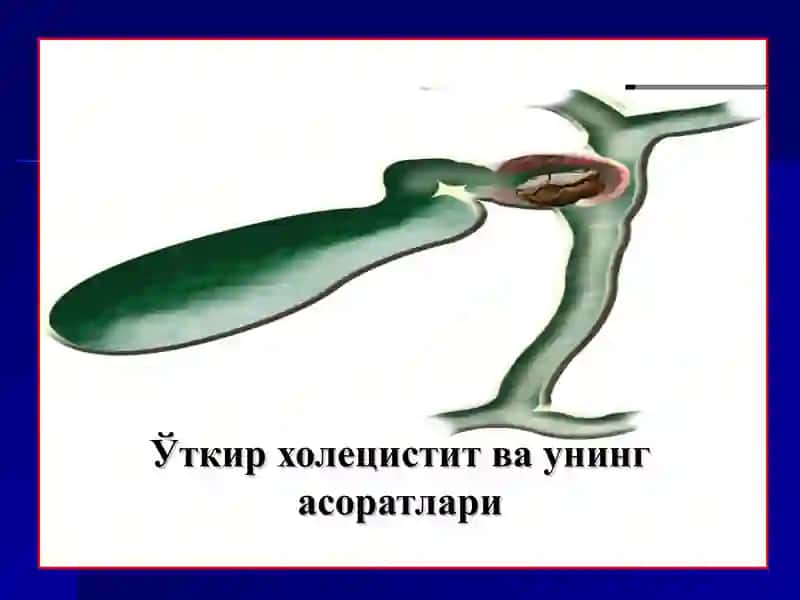 Ўткир холецистит ваунингасоратлари 2