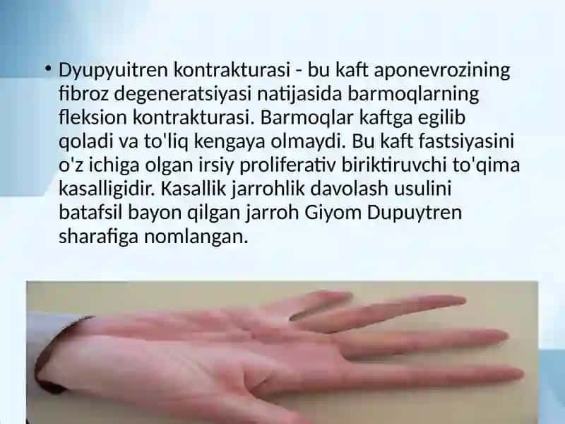 Dyupyuitren kontrakturasi 2
