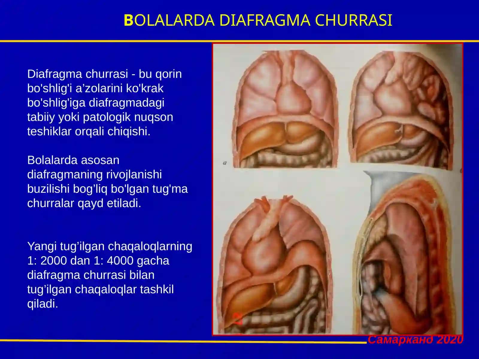 BOLALARDA DIAFRAGMA CHURRASI 2