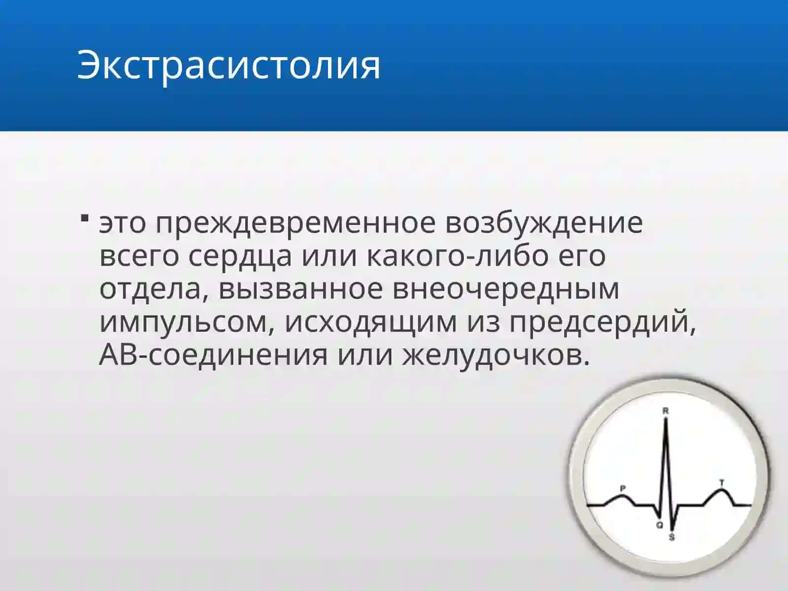 Экстрасистолия 2