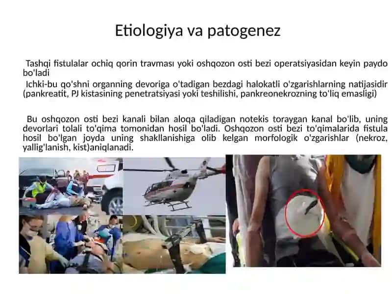 Oshqozon osti bezi fistulalari 2