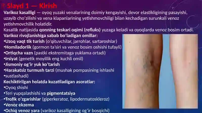 Oyoq venalarining varikoz kasalligida bajariladigan operatsiyalar. 2