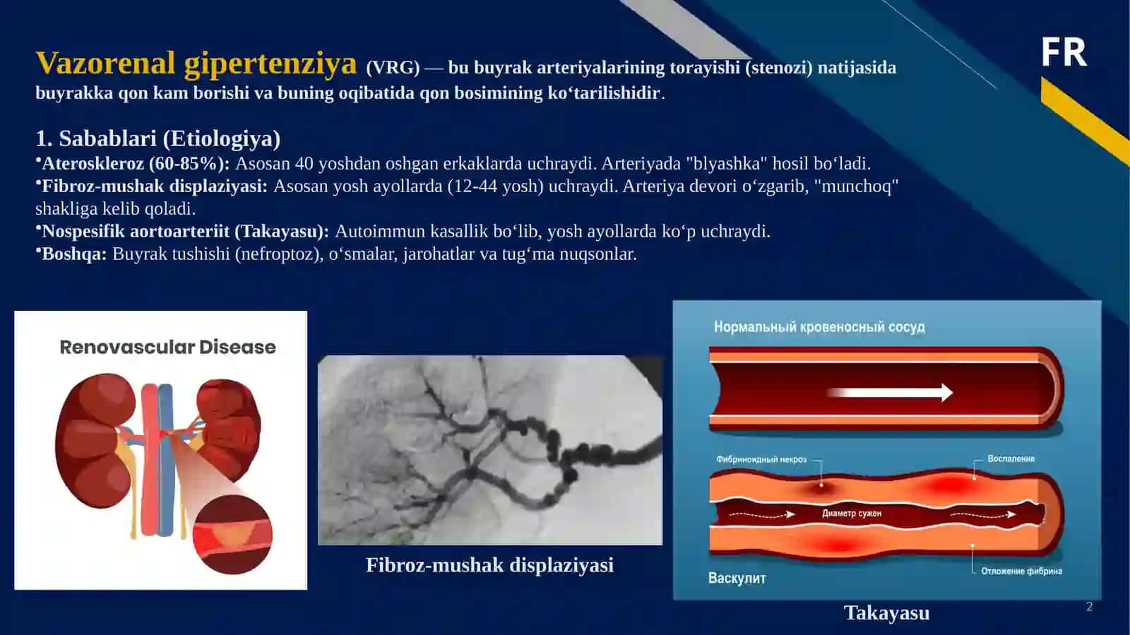 Simptomatik arterial gipertenziya, O‘tkir arterial tutilishi 2