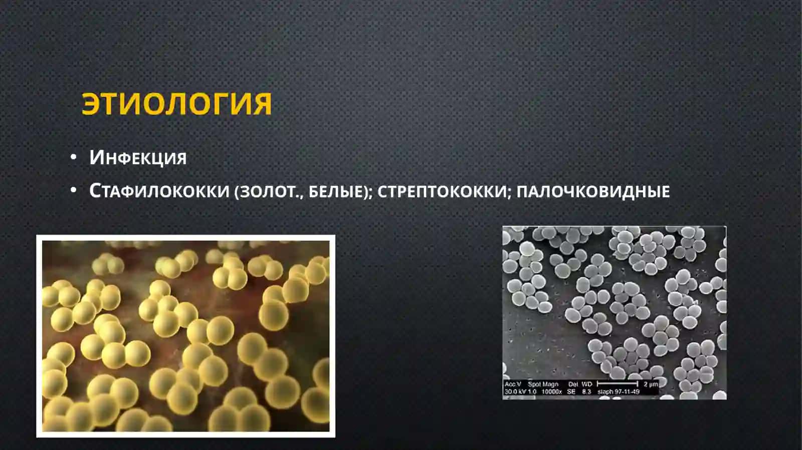 Одонтогенныйостеомиелитчелюсти 2