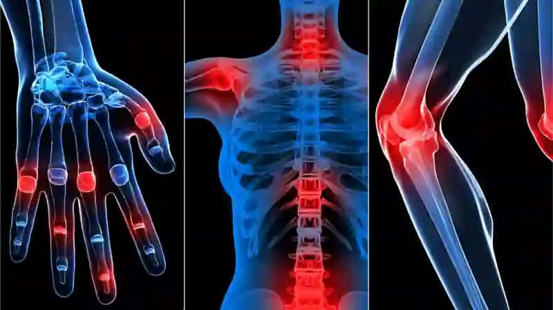 Osteoartrit 2