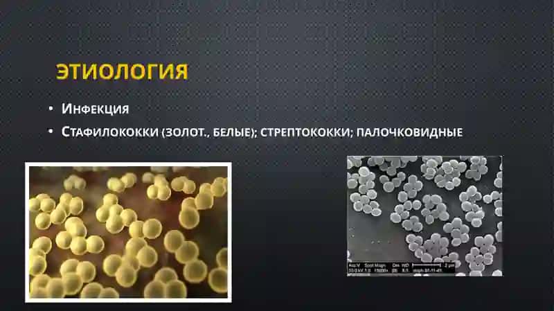 Одонтогенный остеомиелит челюсти 2