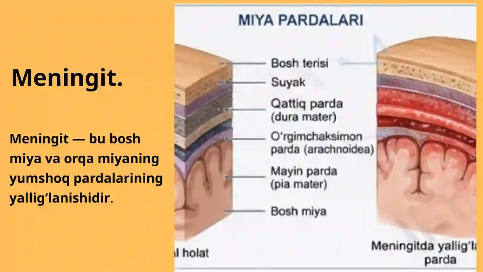 Meningit 2