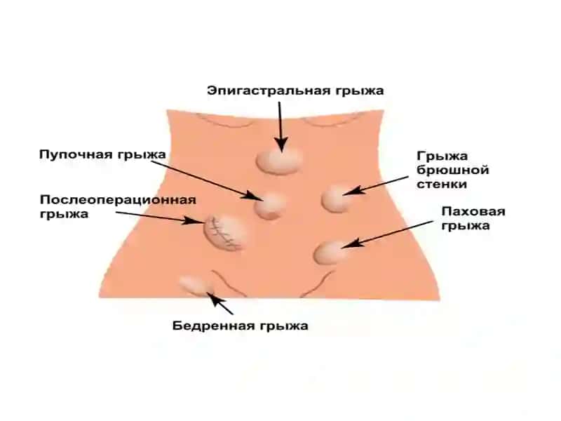 Qorin churrasi (churra abdominalis) 2