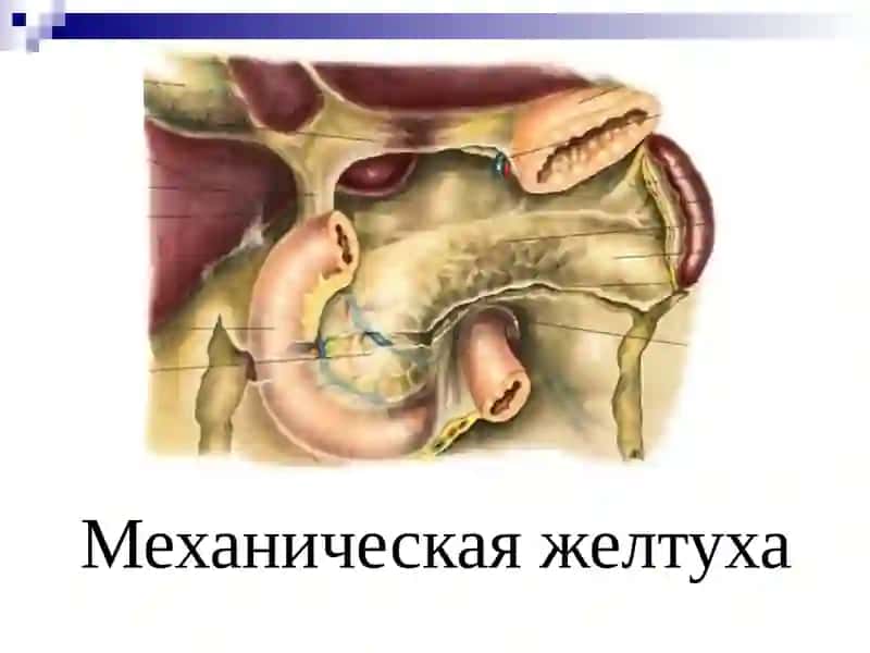МЕХАНИЧЕСКАЯ ЖЕЛТУХА 2