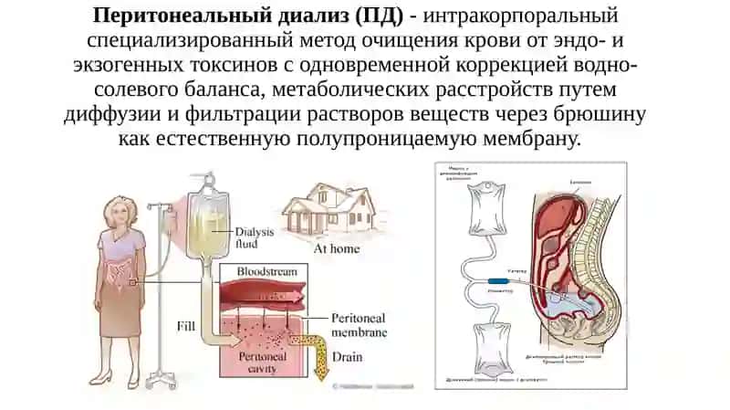Перитонеальный диализ. Гемодиализ 2