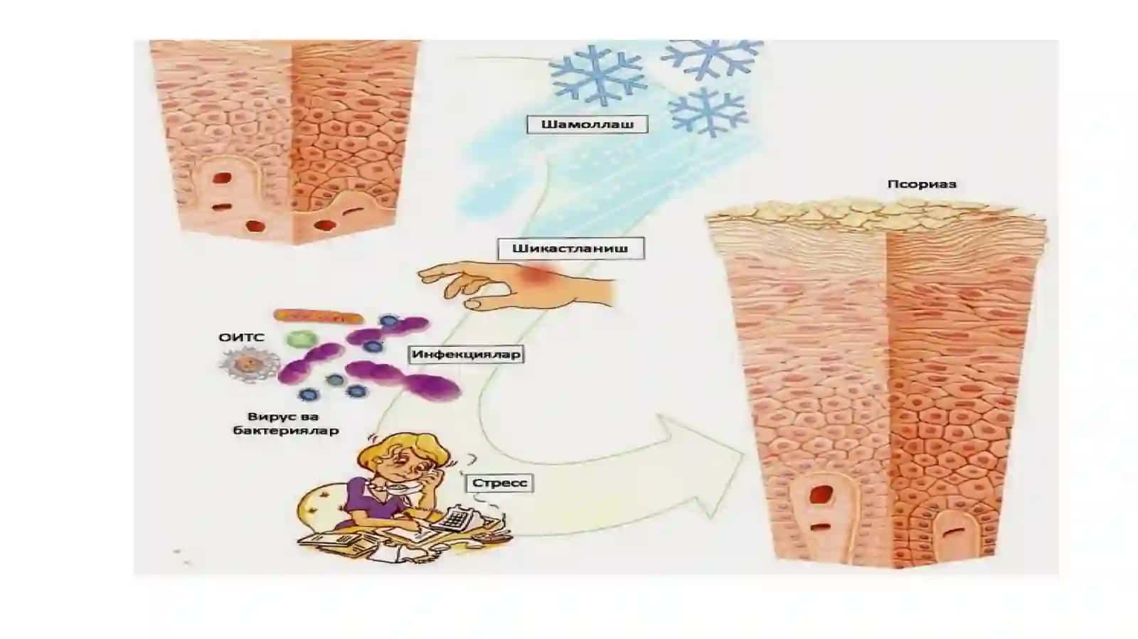 JIBERNING PUSHTI RANGLI TEMIRATKISI(PITYRIASIS ROSEA GIBERT) 2