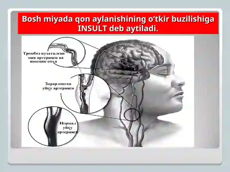 Miyada qon aylanishining buzilishi 2