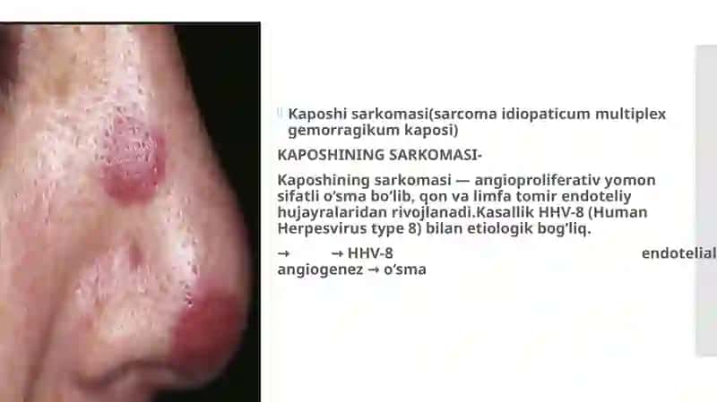 Kaposhining sarkomasi. Ekzema Kaposhi.IFAva PZR diagnostik usullarining dermatovenerologiyada qoʻlla 2