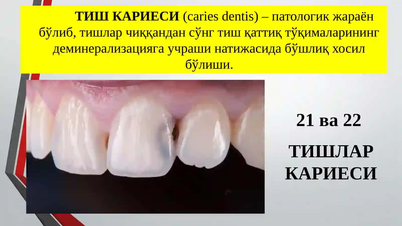 Тиш кариеси 2