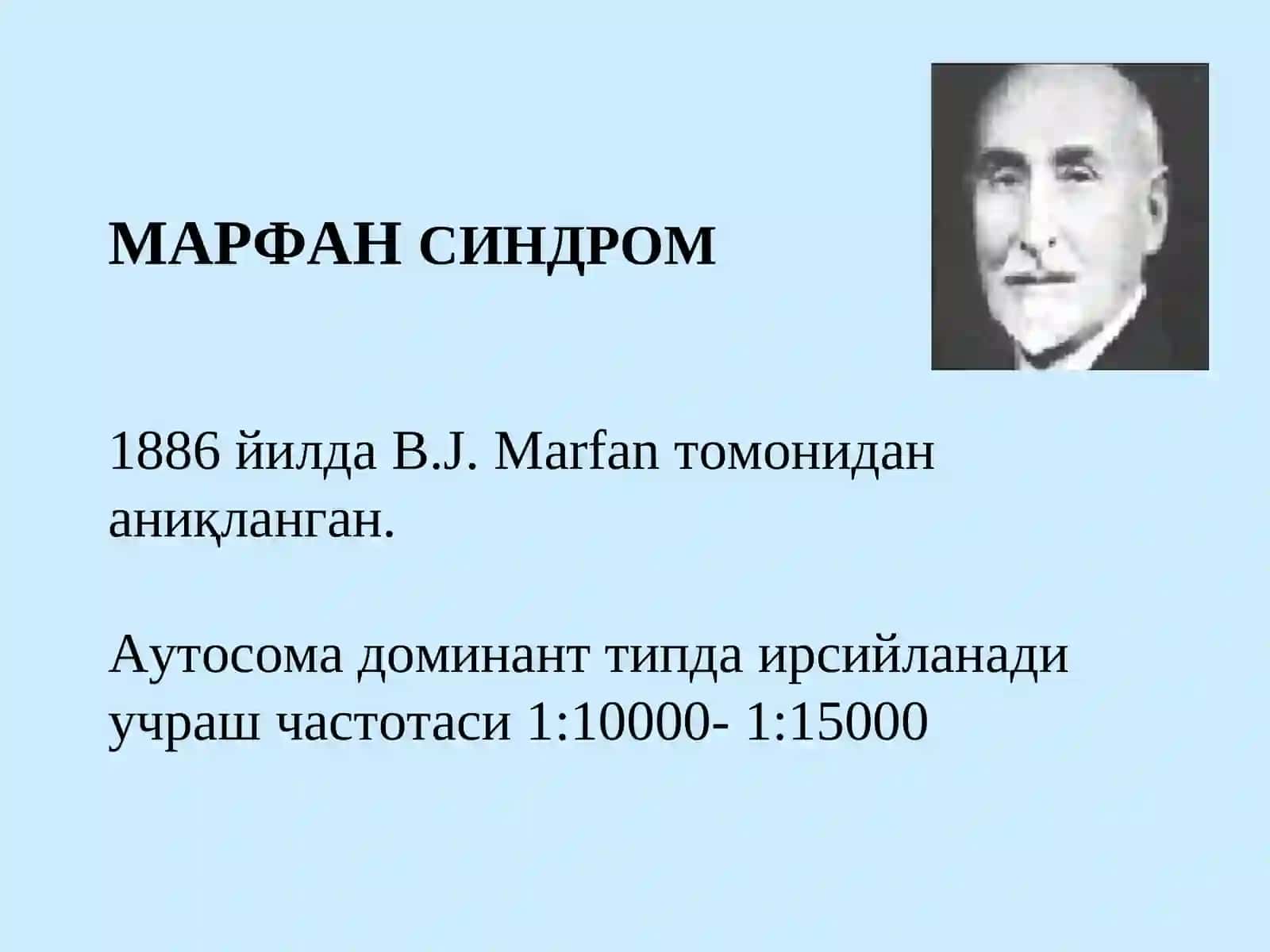МАРФАН СИНДРОМИ 2
