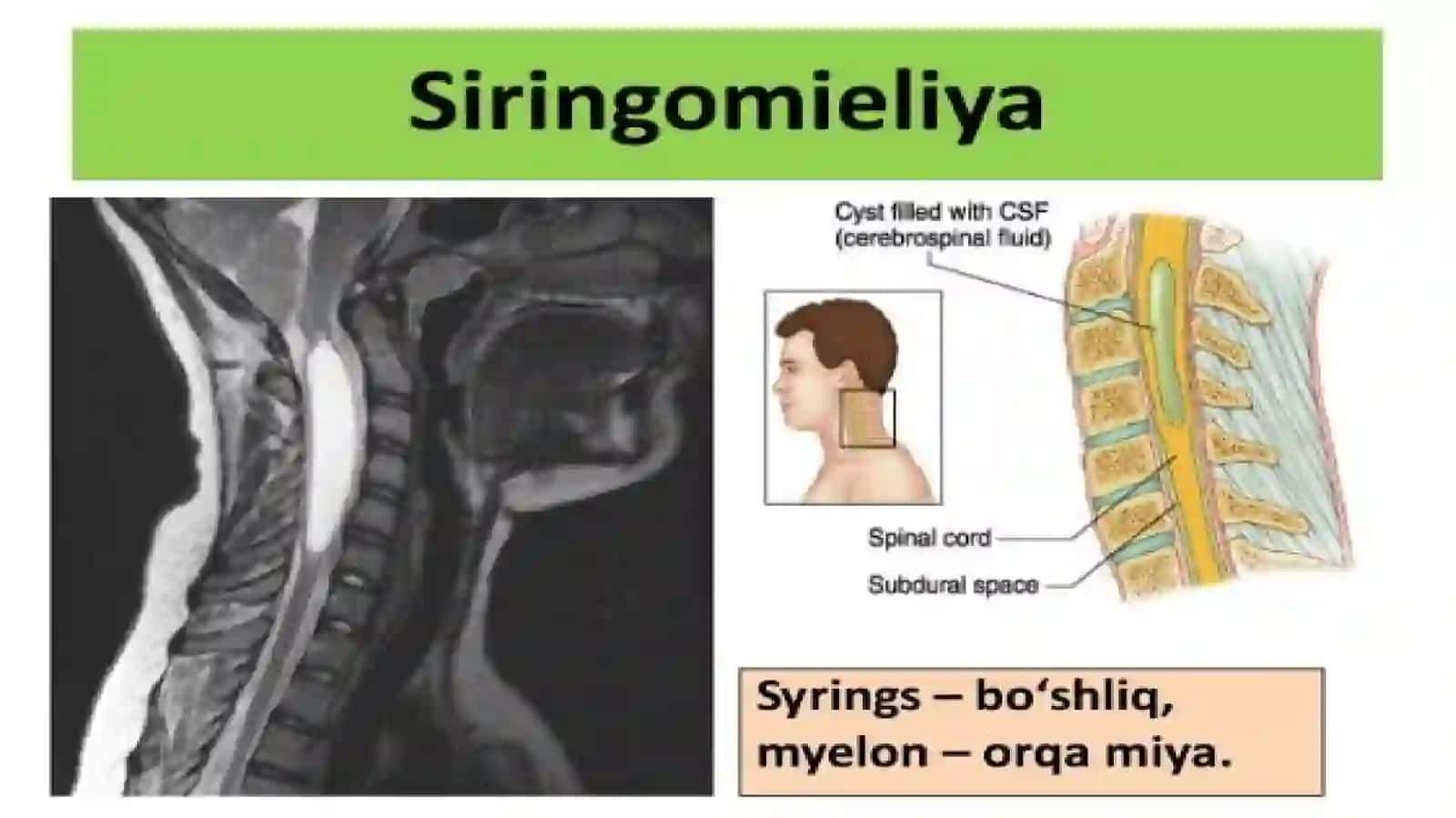 Siringomiyeliya 2