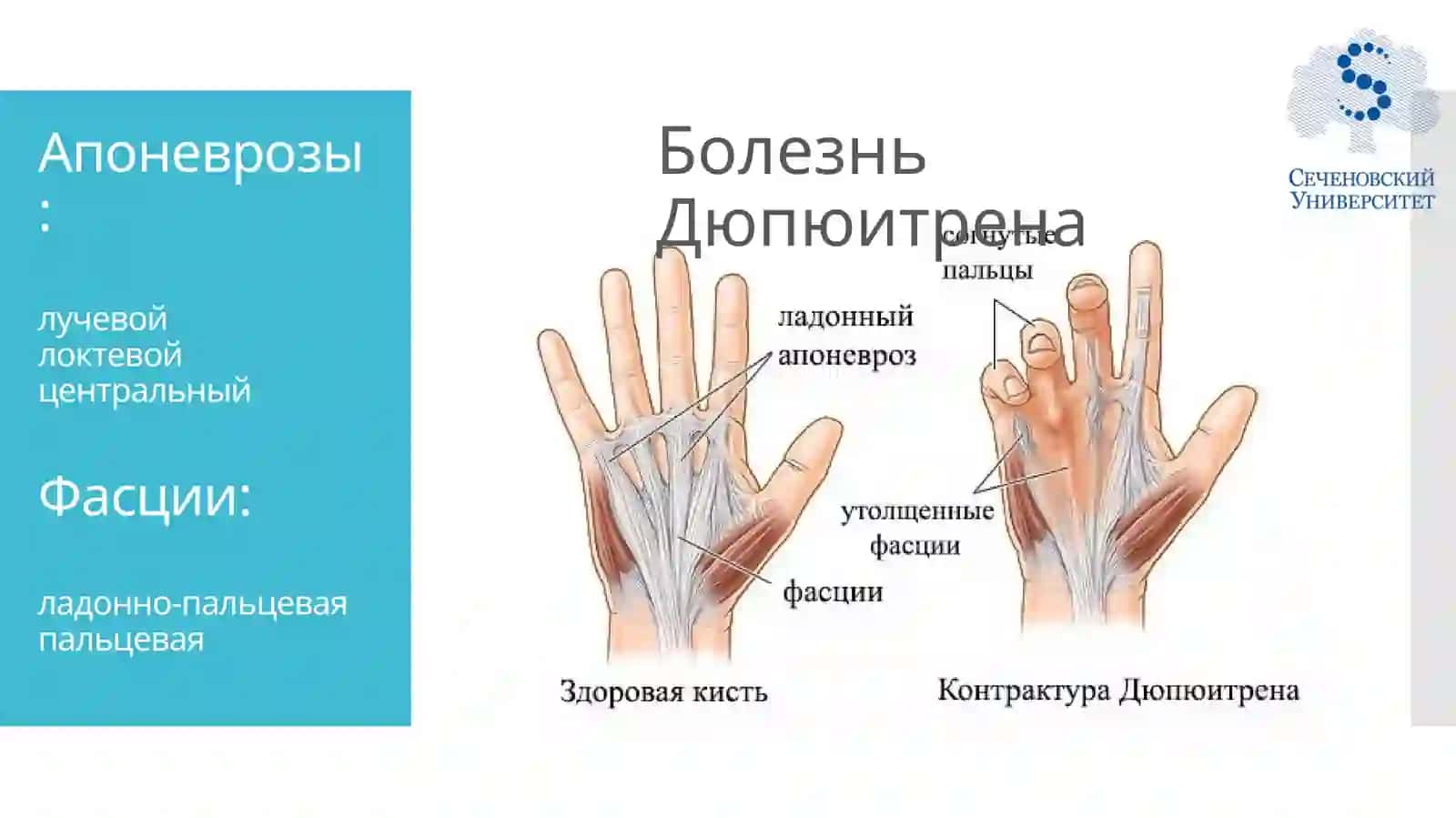 Методы лечения контрактуры Дюпюитрена 2