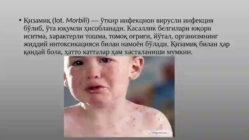 Қизамиқ (MORBILLI) 2